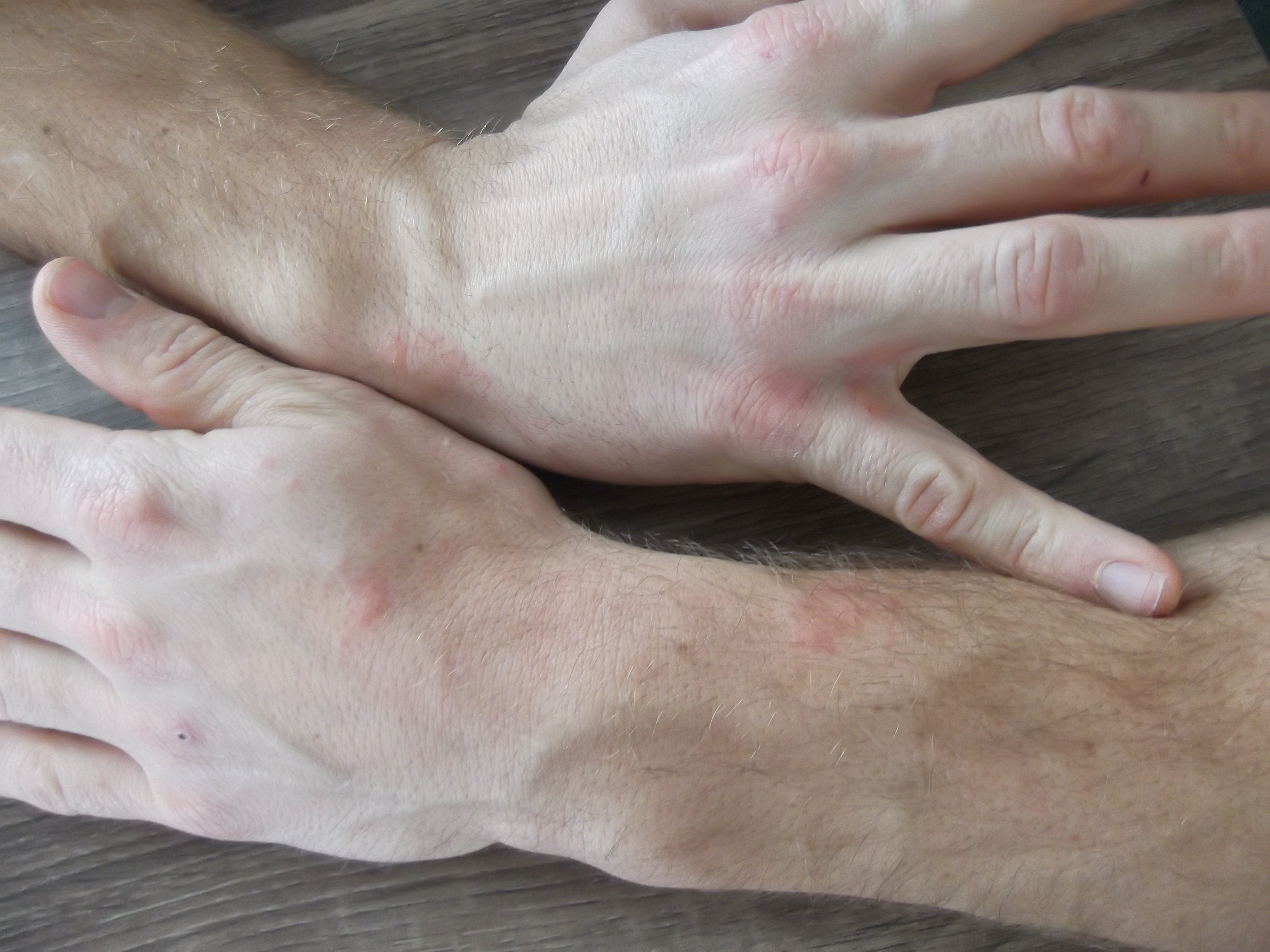 petit bouton sur les mains et pieds petit bouton sur les mains et pieds